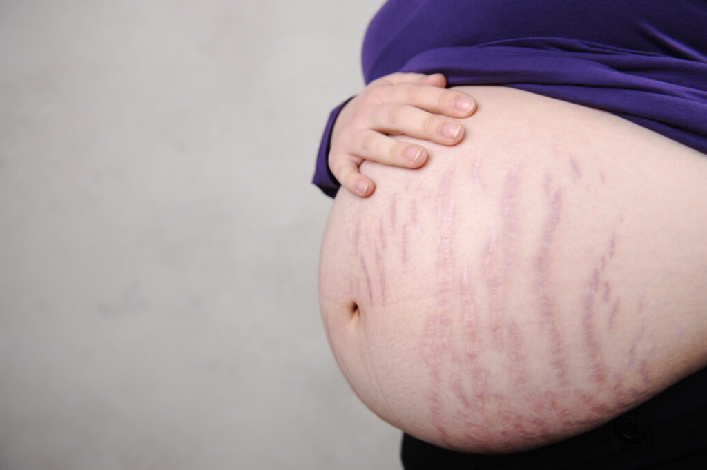 `Pregnant woman with stretch marks